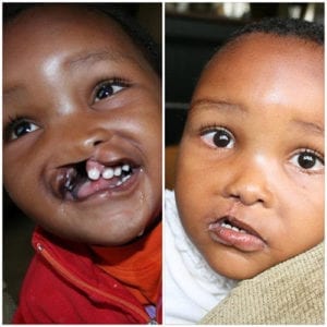 before and after of little girl with cleft palate