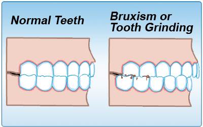 Animated diagram of tooth grinding