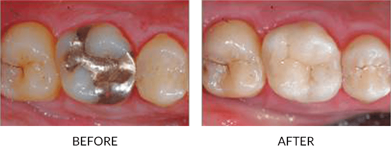 Ceramic Crowns San Diego before and after