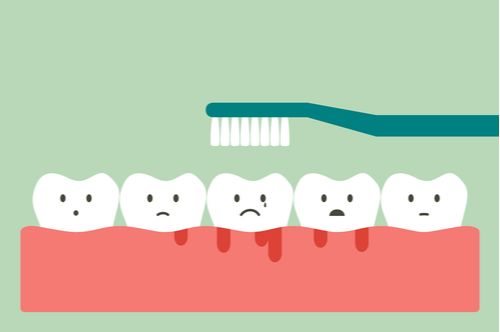 Bleeding gums is a result of poor dental hygiene care. You can take care of gum health by brushing your teeth properly.