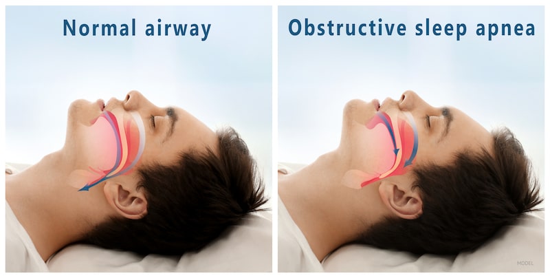 Side by side image example of what happens when a person suffers from sleep apnea.