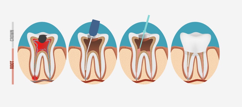 A diagram of a root canal therapy
