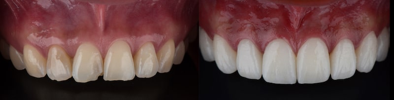 Before and after picture of discolored and damaged teeth that have been treated with a smile makeover.