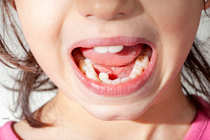 A young girl shows her crowded and now misaligned teeth.