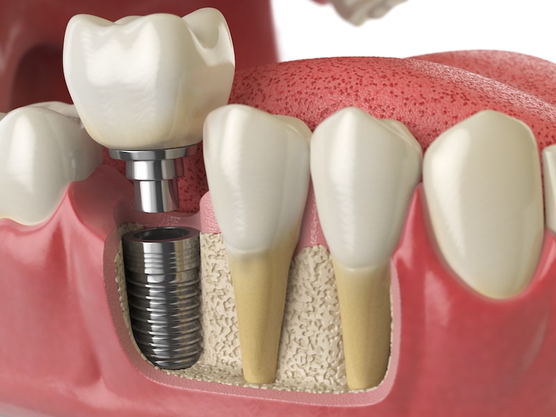 An illustration of a dental implant to replace a missing tooth.