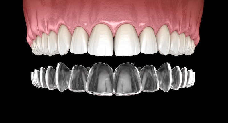 A vector illustration of clear dental aligners.