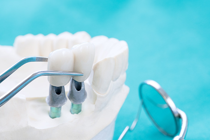 The image shows two complete dental implants on a white model of natural teeth against a blue background.